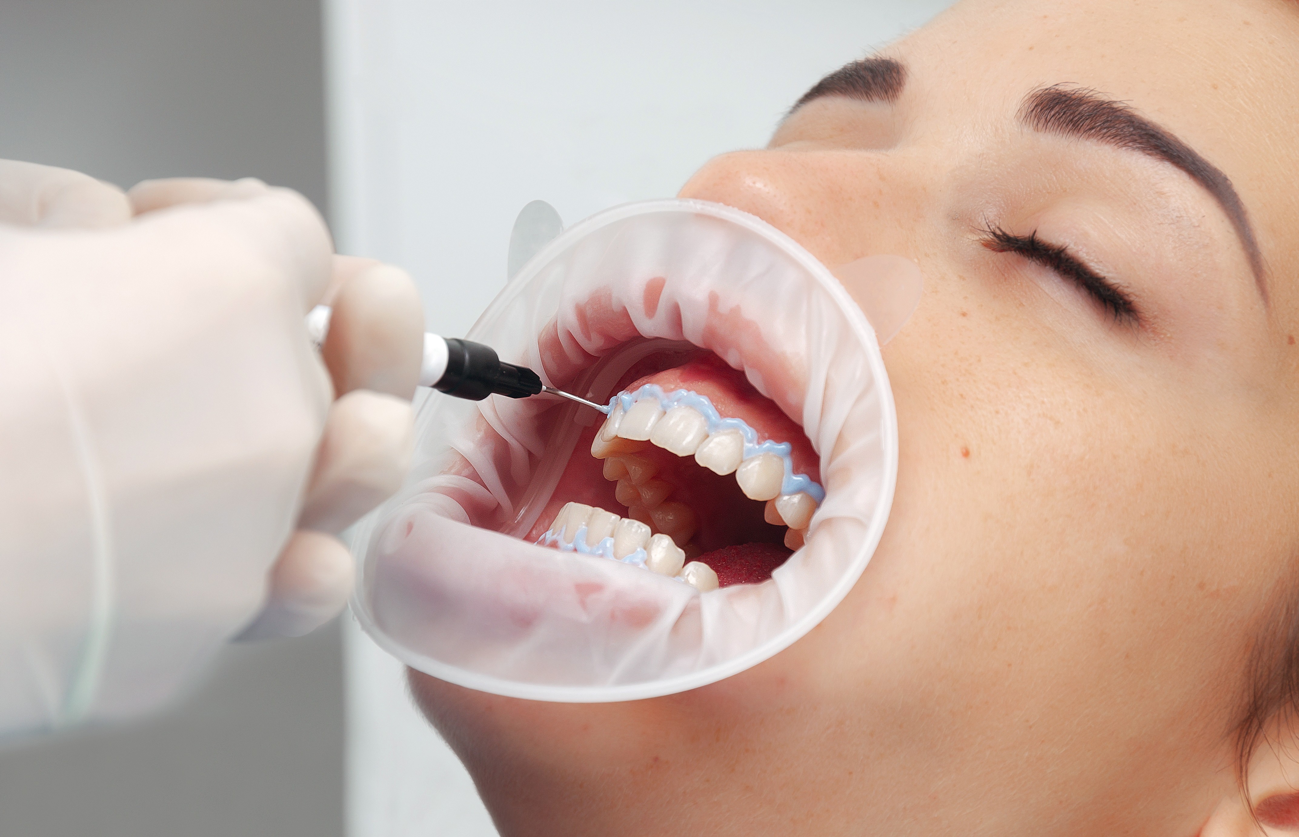 Gummy smile: treatment in a dental clinic