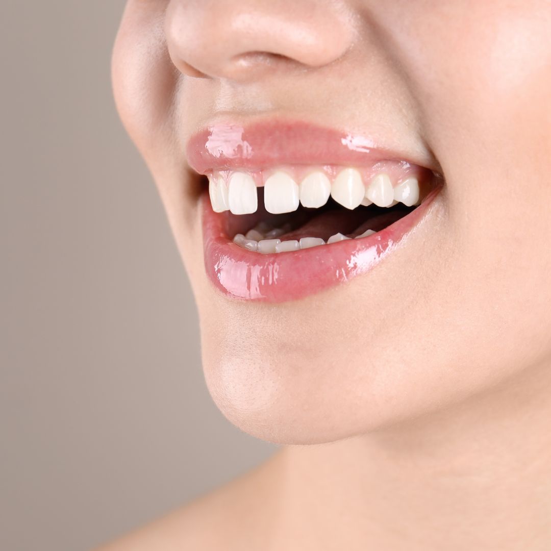 Perfectly aligned teeth after orthodontic smile treatment at Dentistree Kolkata.