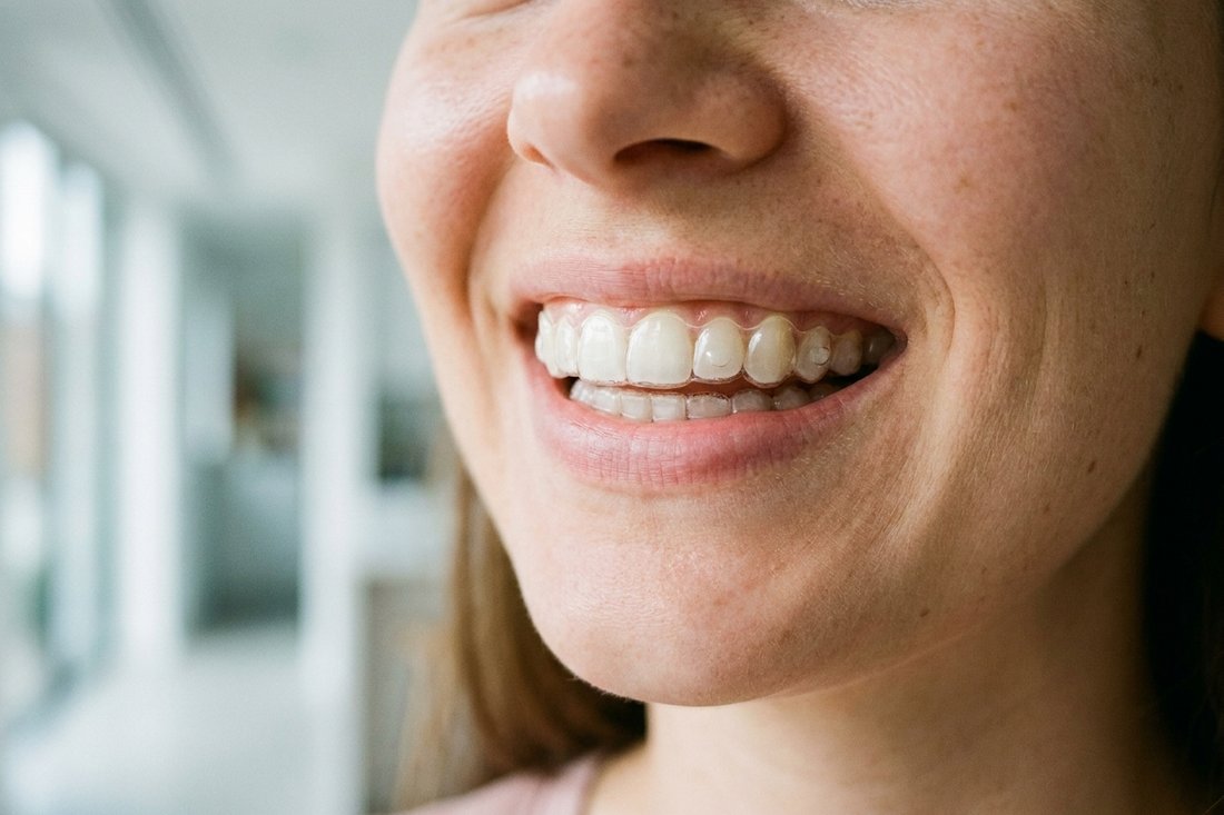 Smiling young woman wearing a clear aligner over straight teeth