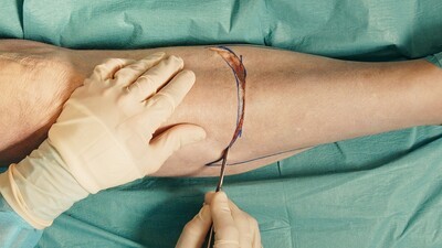 Below knee amputation