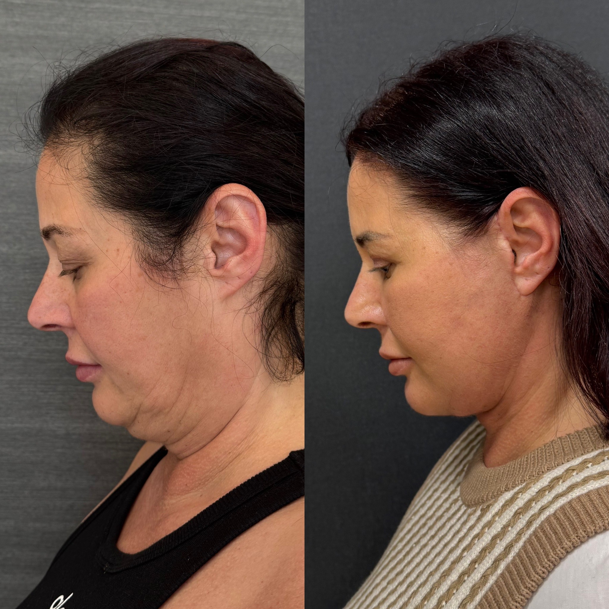 deep plane neck lift 1 month result before after photo side view