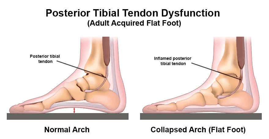 Illustrations of Posterior Tibial Tendon Dysfunction