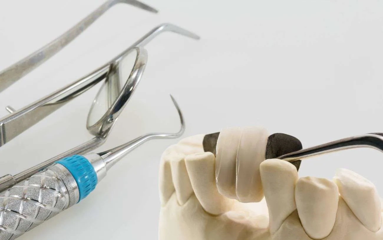 cantilever dental bridge