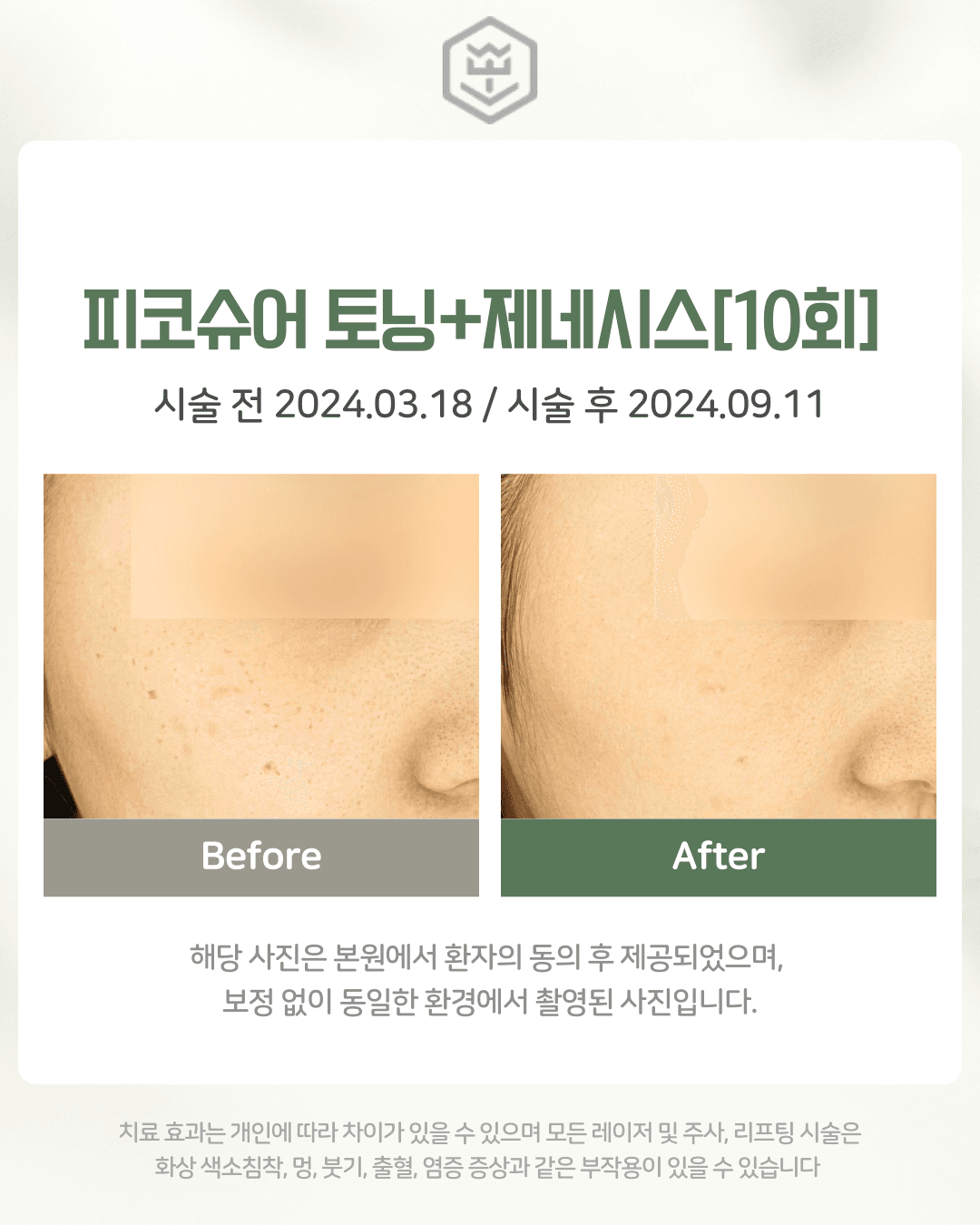 피코슈어+제네시스 10회