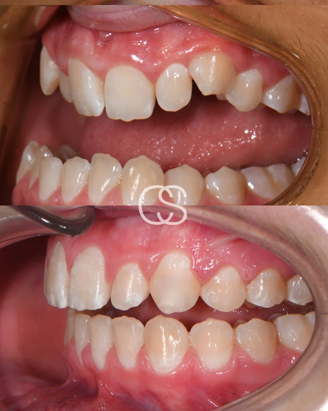 Before & After Braces at Colac Smiles, Colac