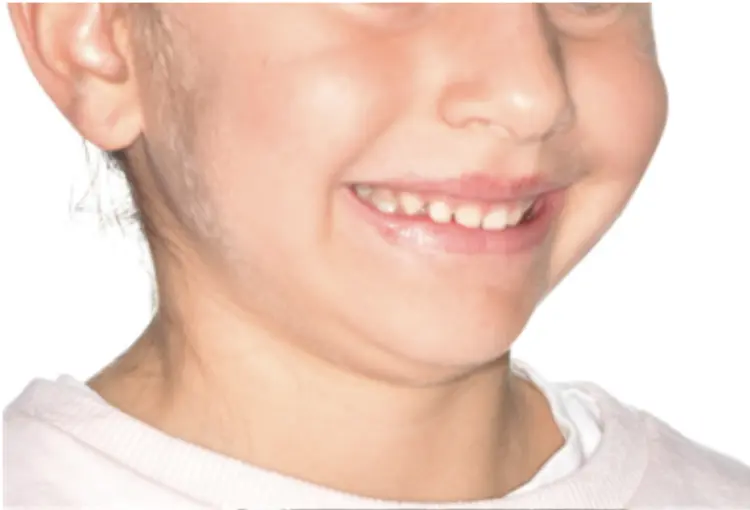 Before and after comparison: more relaxed smile, less muscle tension after “unblocking” the deep bite and “releasing” the lower jaw forward. Profile changes, better lip competence.