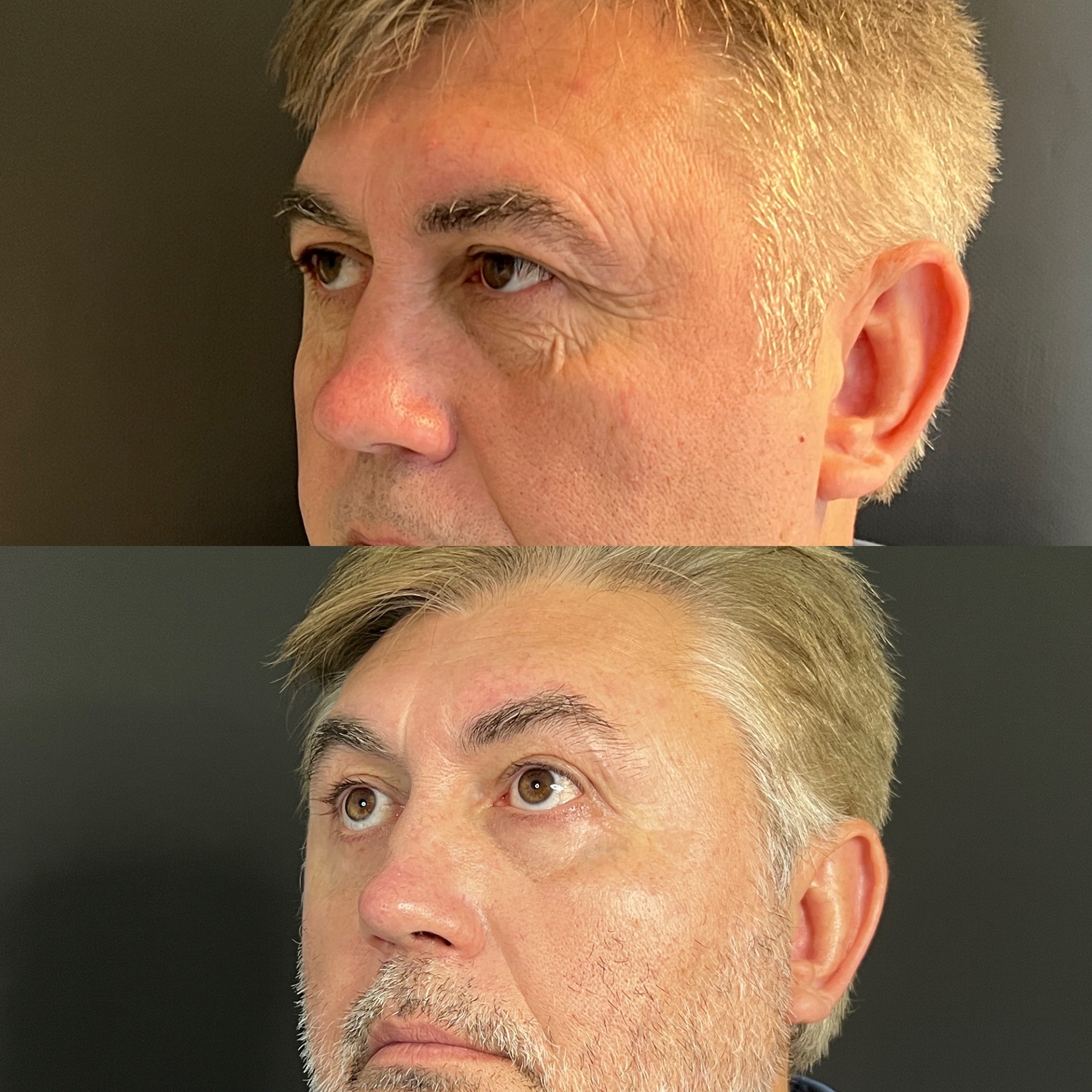 upper and lower blepharoplasty before after 1 month post-op left oblique view