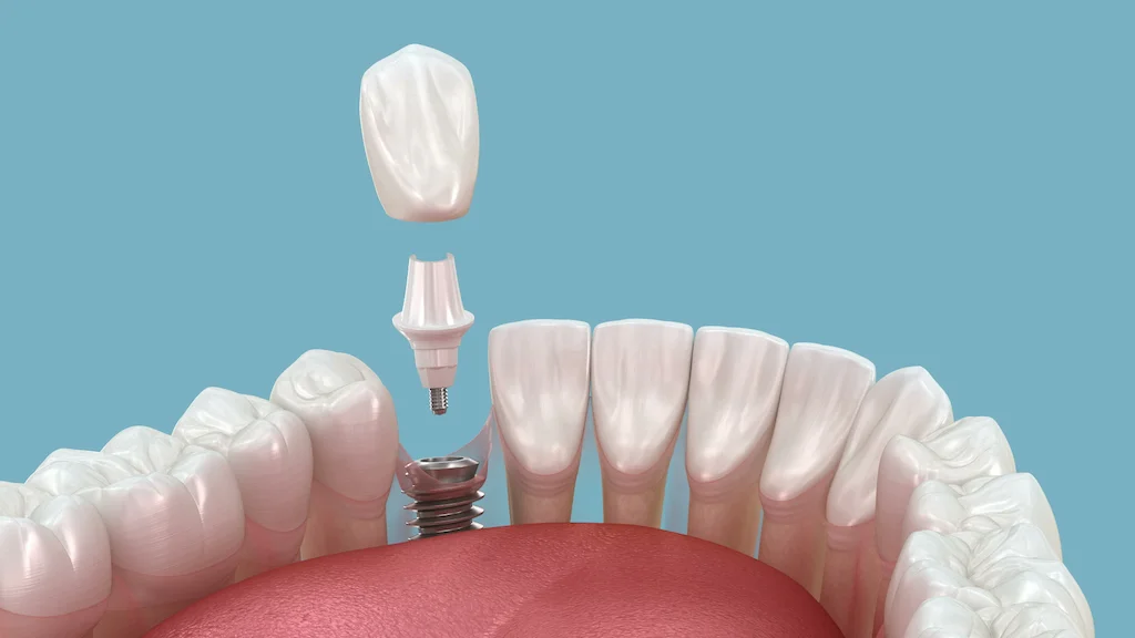 Implante dentário unitário para substituição de um único dente