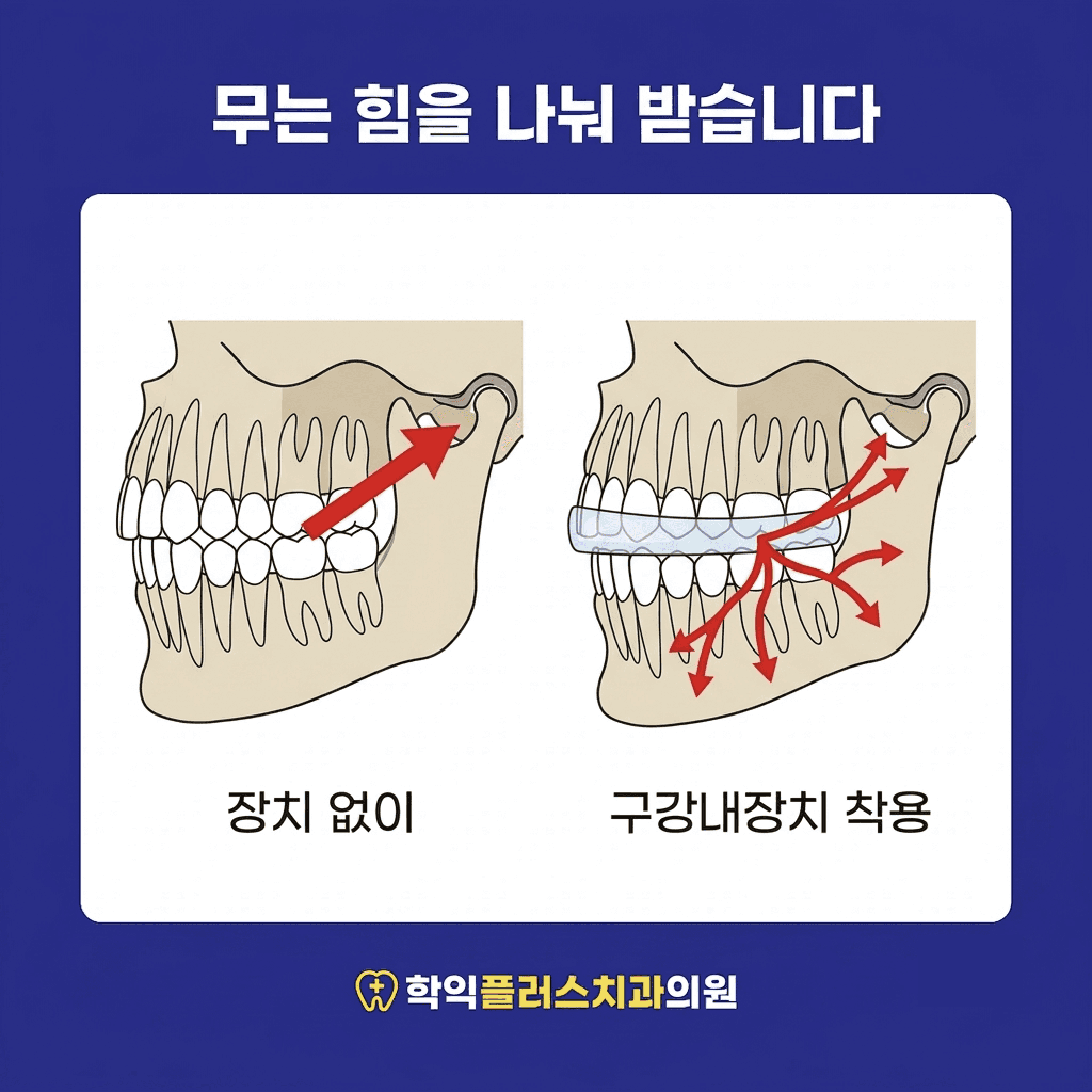 구강내장치의 역할 — 턱관절에 실리는 무는 힘을 분산하는 구조