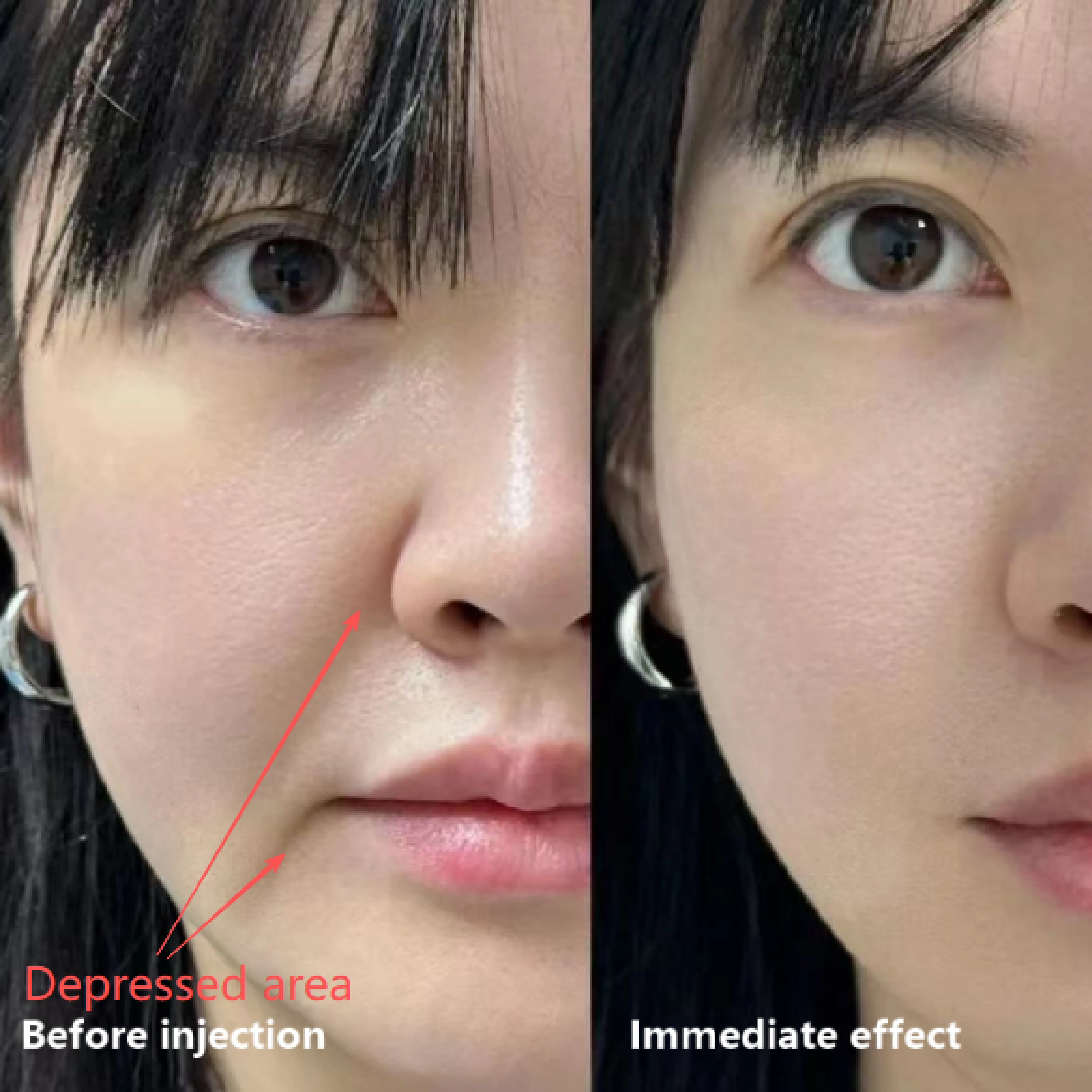 Poly(L-lactic Acid) Injectable Facial Filler Microspheres Factory