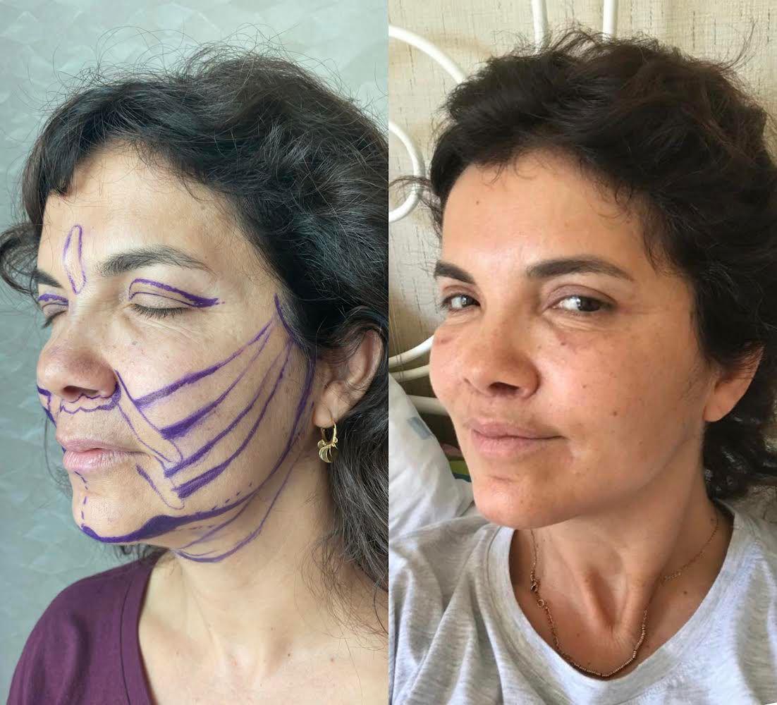 Face & Neck Lift