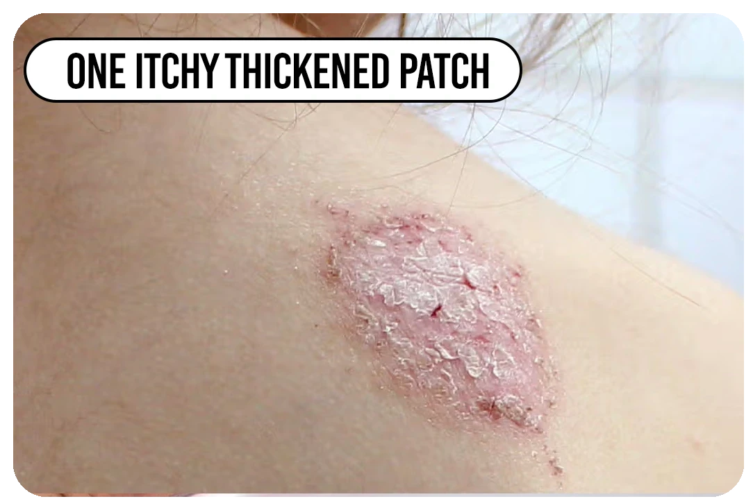 One itchy thickened patch