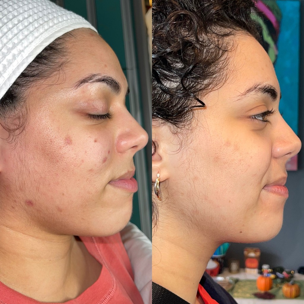 best-acne-treament-facial-san-diego-ca