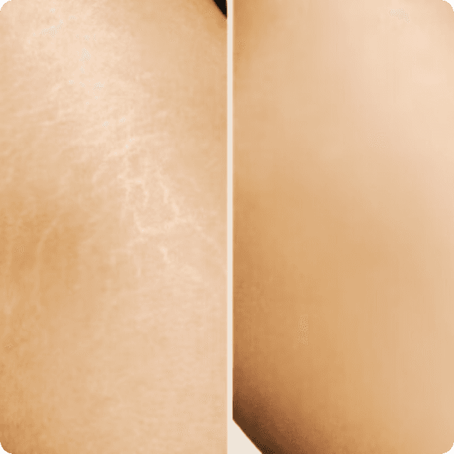 Before-and-after comparison showcasing a person's skin before and after stretch mark treatment. The 'before' image highlights visible stretch marks on the skin, while the 'after' image reveals a significant reduction in their appearance, showcasing smoother and more even skin tone. The individual has a relaxed expression in both images, reflecting the positive results of the treatment.