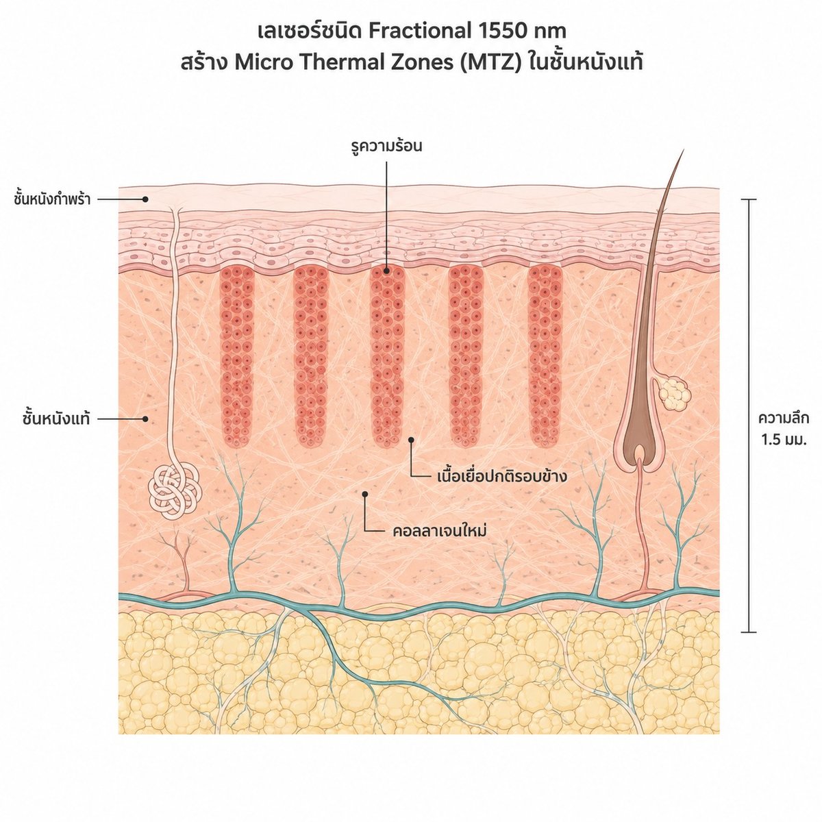 ภาพตัดขวางผิวแสดงการทำงานของ Fraxel Fractional Laser ในชั้นหนังแท้
