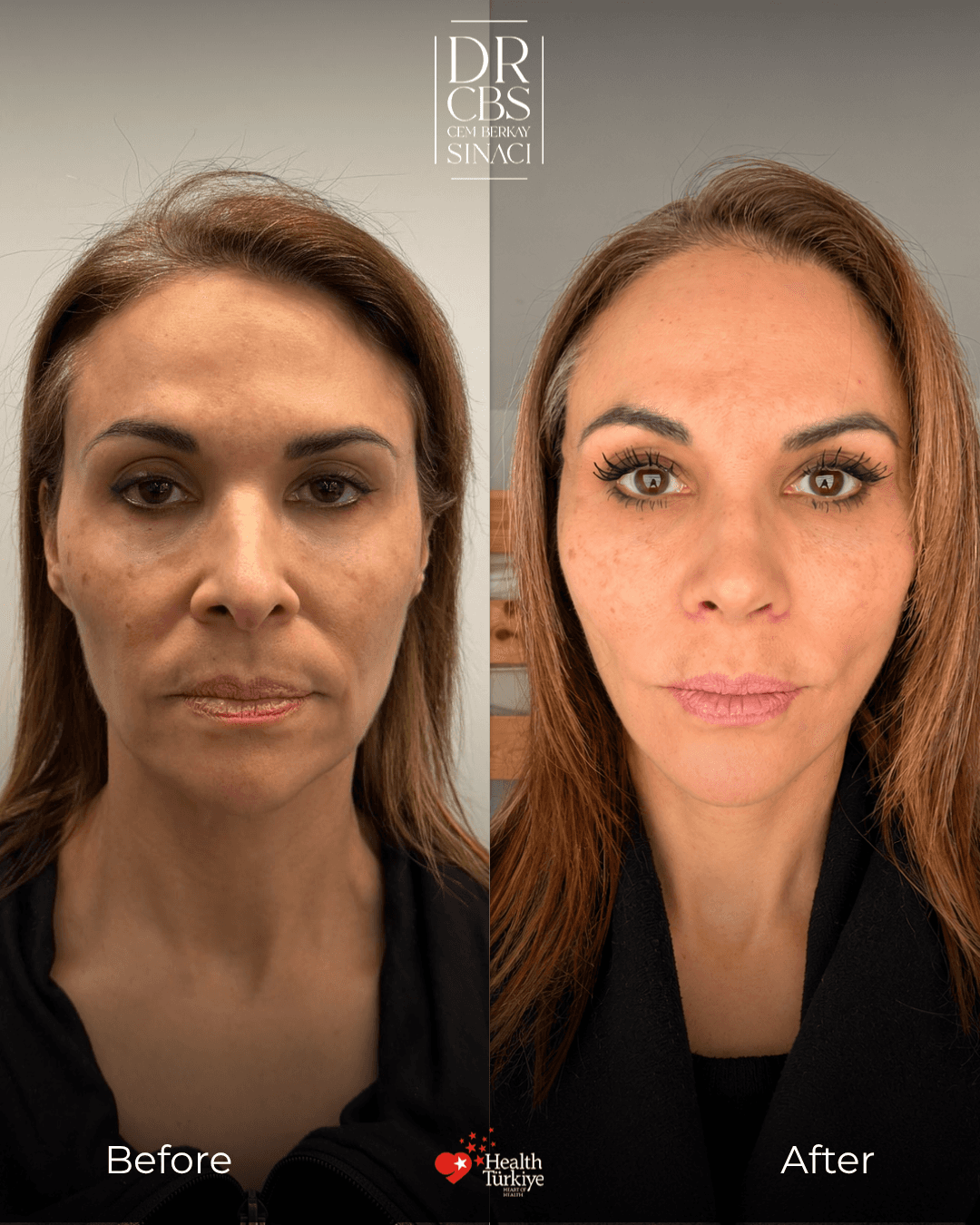 deep plane face neck lift and rhinoplasty before after front view