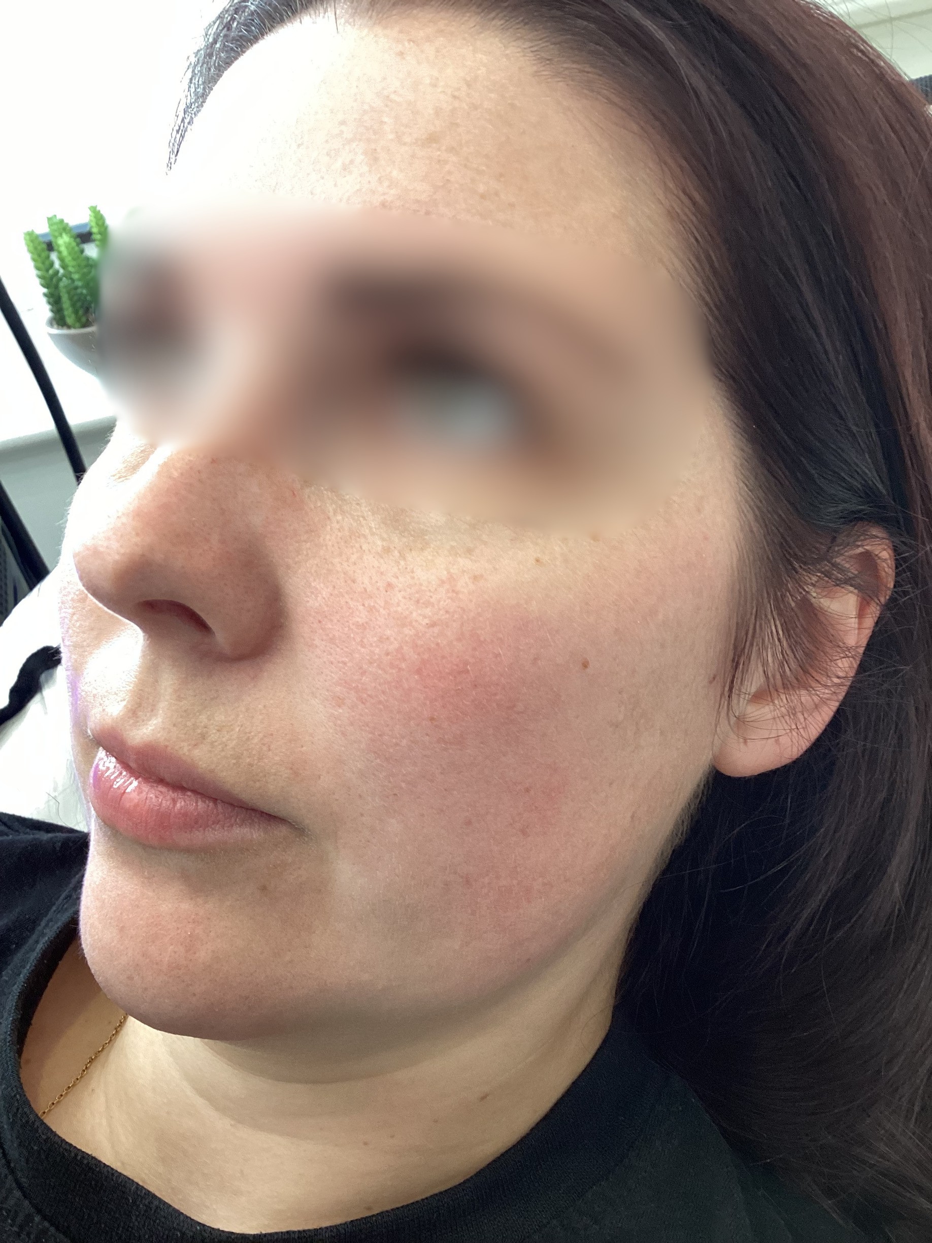 Laser treatment on woman's cheek with protective eye shield