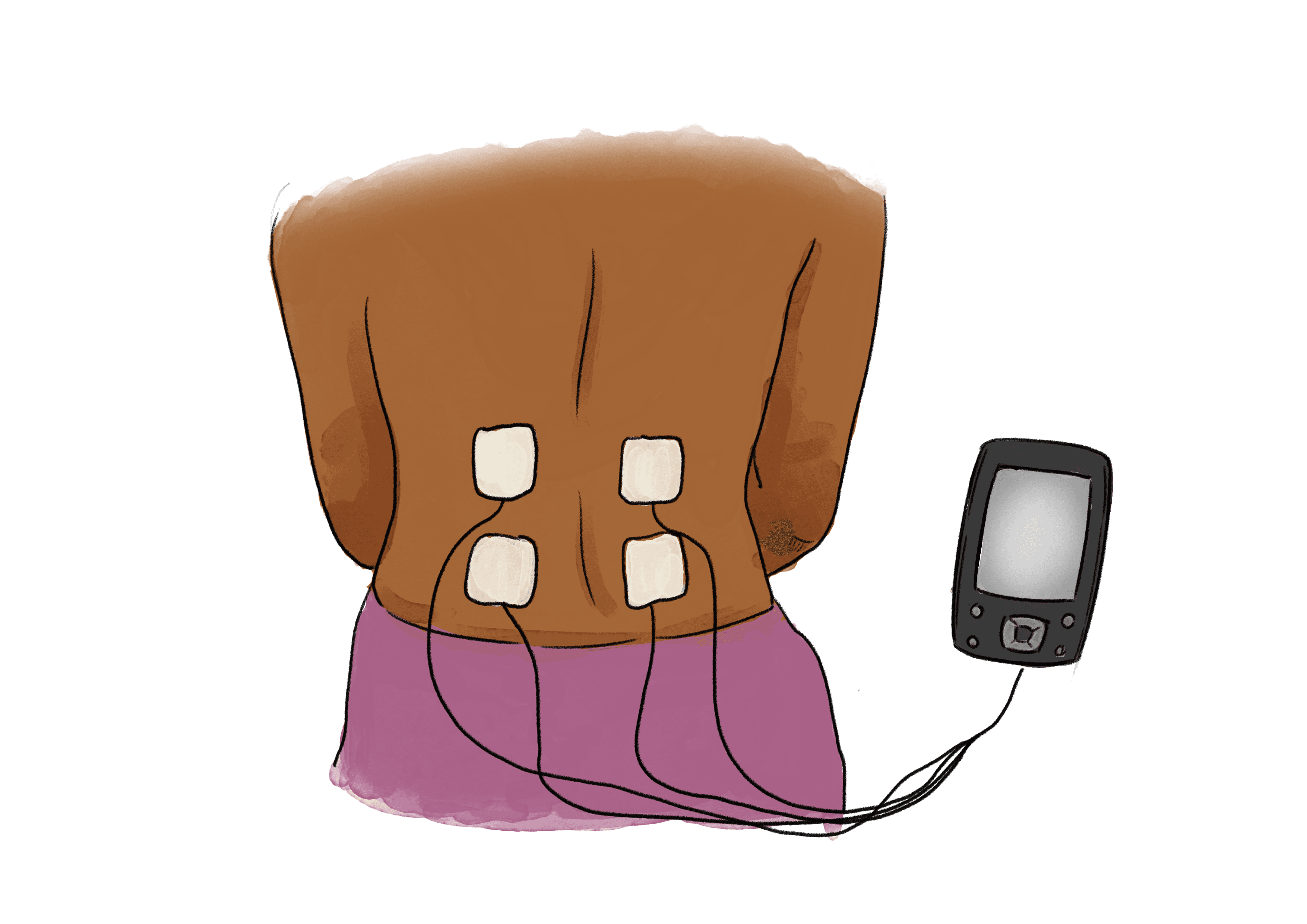 An illustration of a woman's back with TENS machine pads placed on the lower half of their back. They are attached by wire to a TENS machine.