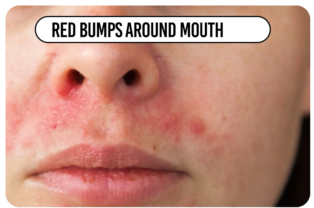 Red bumps around mouth