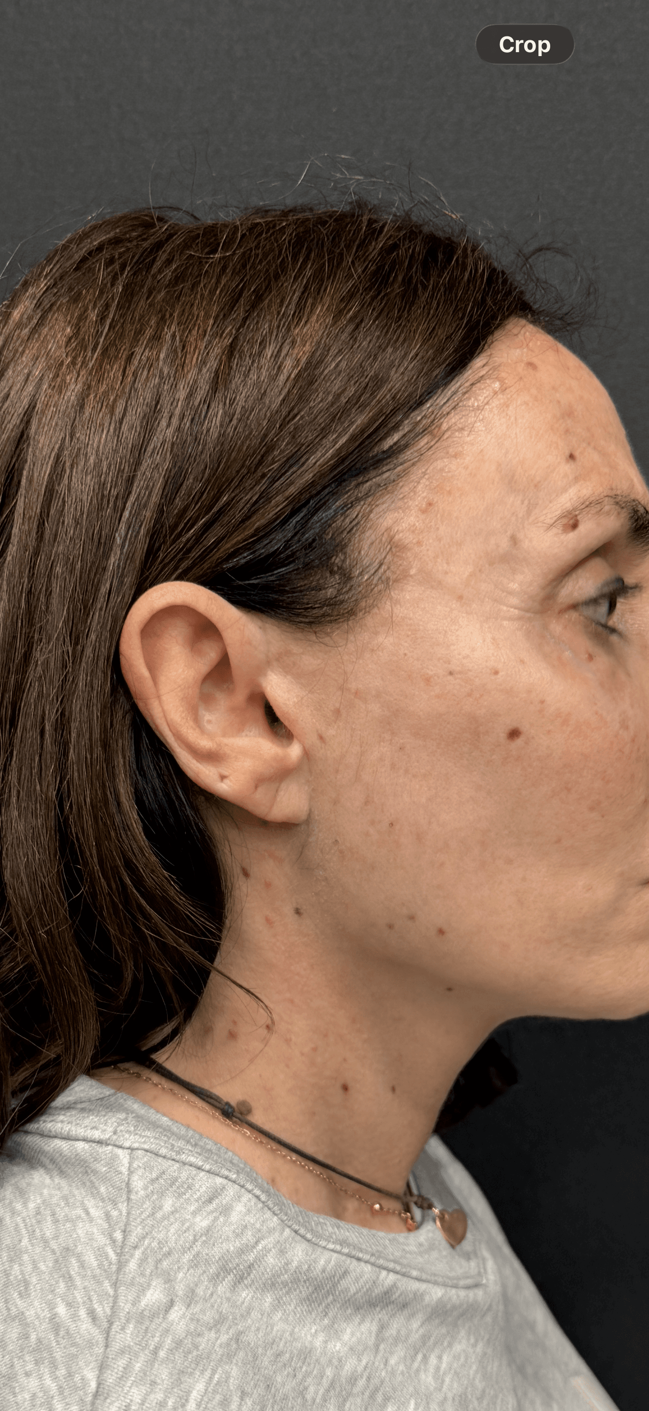 Facelift scar 6 months after retro-tragal incision — tragus definition restored