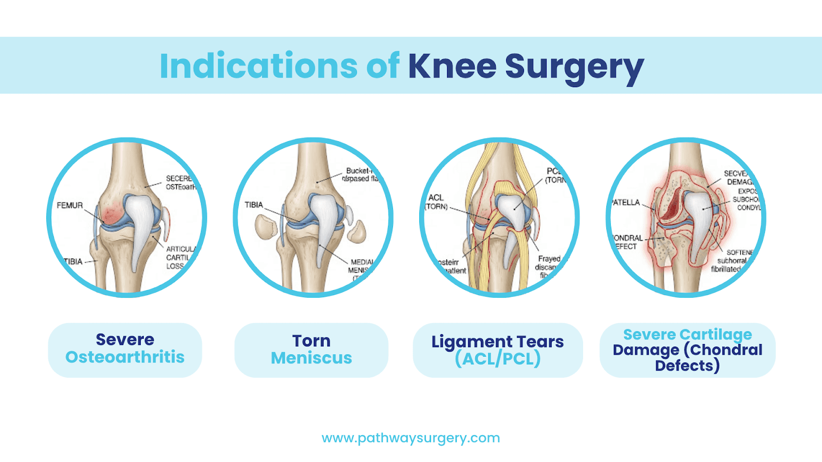 The top four indications of private knee replacement.