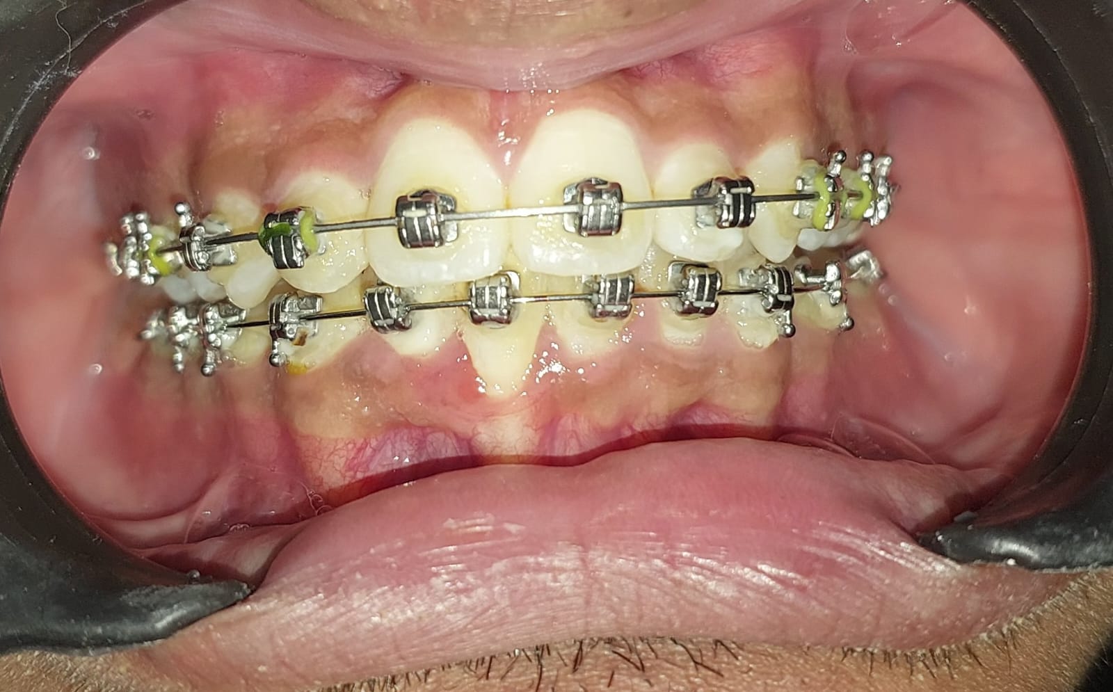 Metal braces image