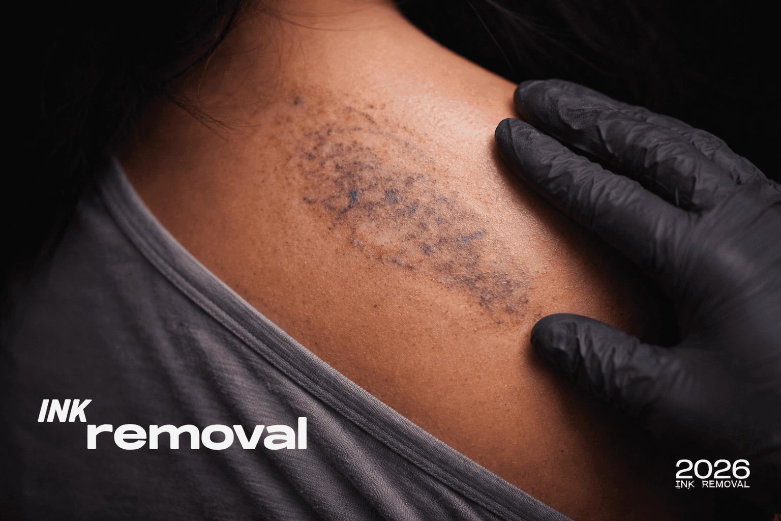 Faded tattoo with light scarring shown during tattoo removal healing process.