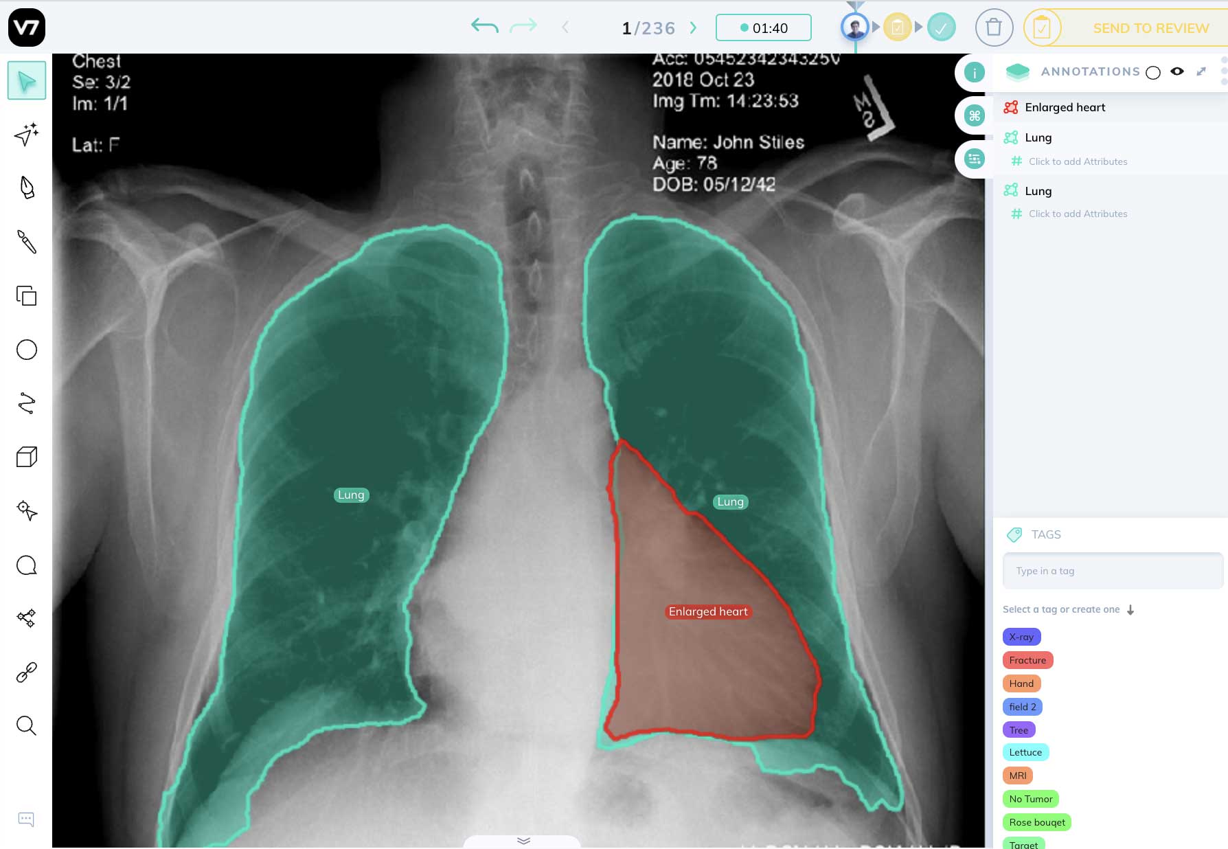 AI chest X-Ray annotation analysis in V7