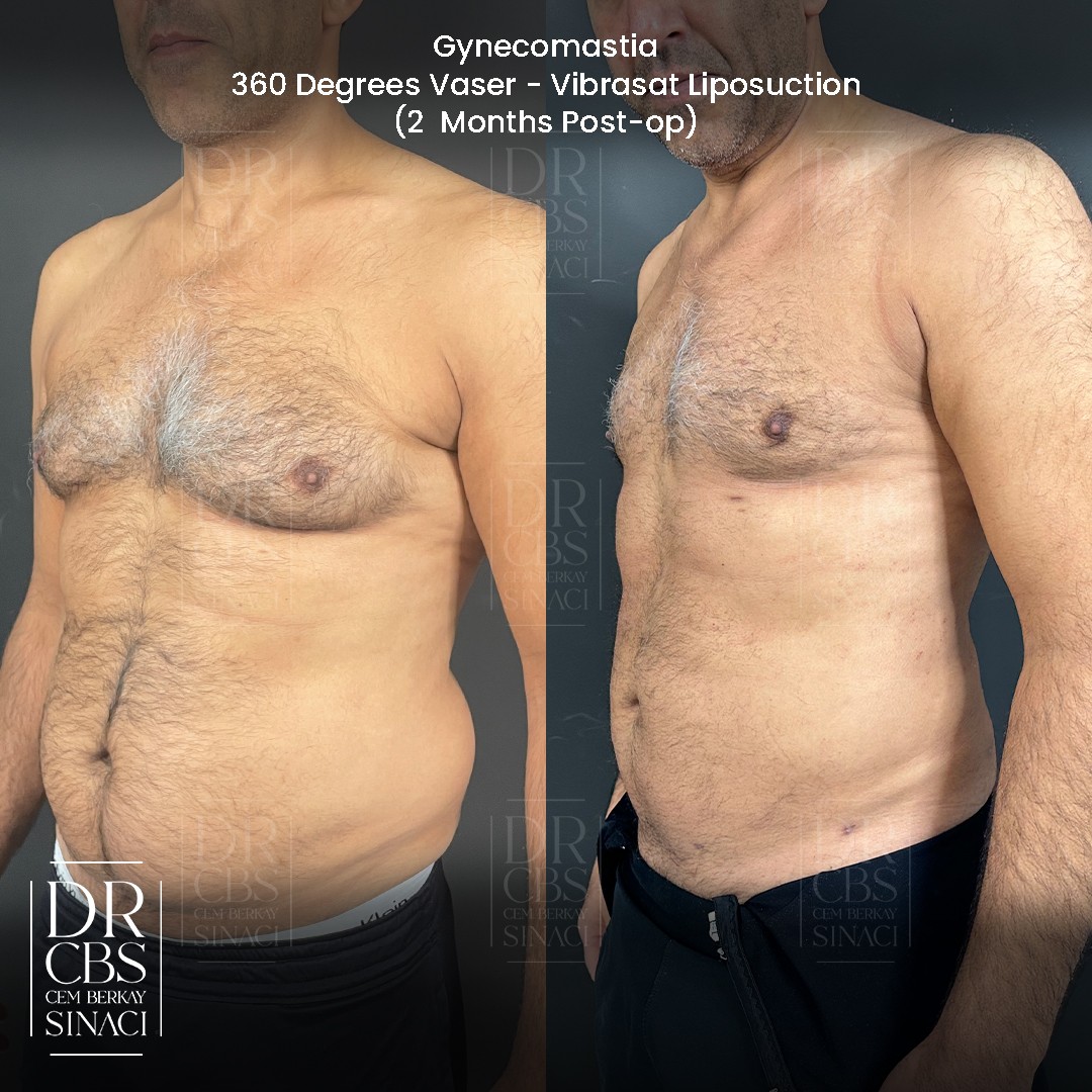 gynecomastia correction vaser liposuction and laser skin tightening for abdomen before after oblique view