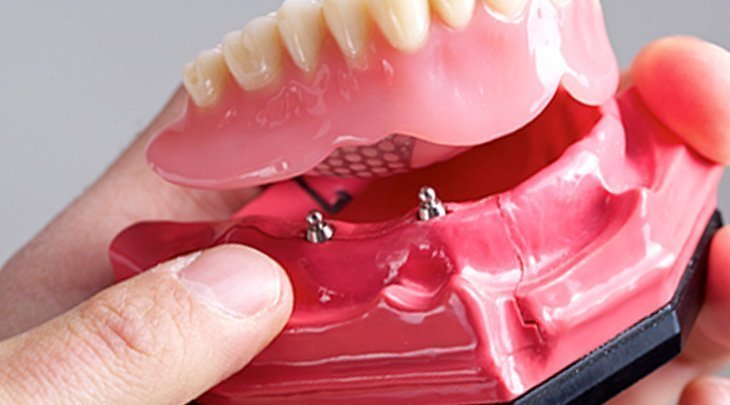 Snap-on denture being placed at Smyrna Dental Studio