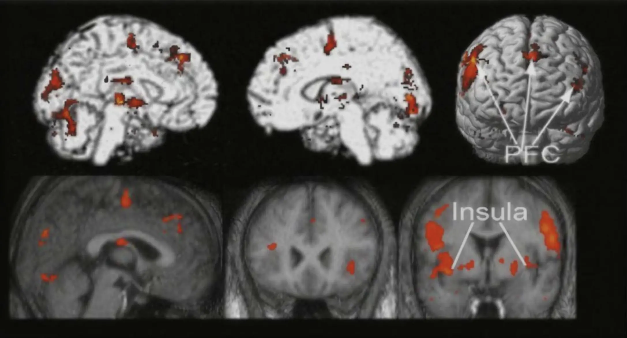 Brain activity (limbic system hyper responsiveness) whilst bruxing with a functional (left) and dysfunctional occlusion (right)
