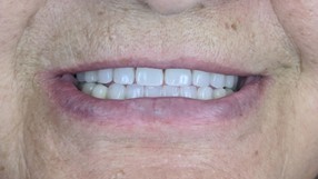 Fogászati Implantátum Tájékoztató