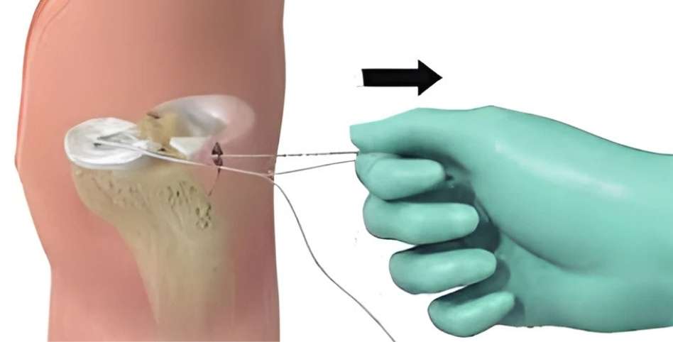 JuggerStitch™ Meniscal Repair Device