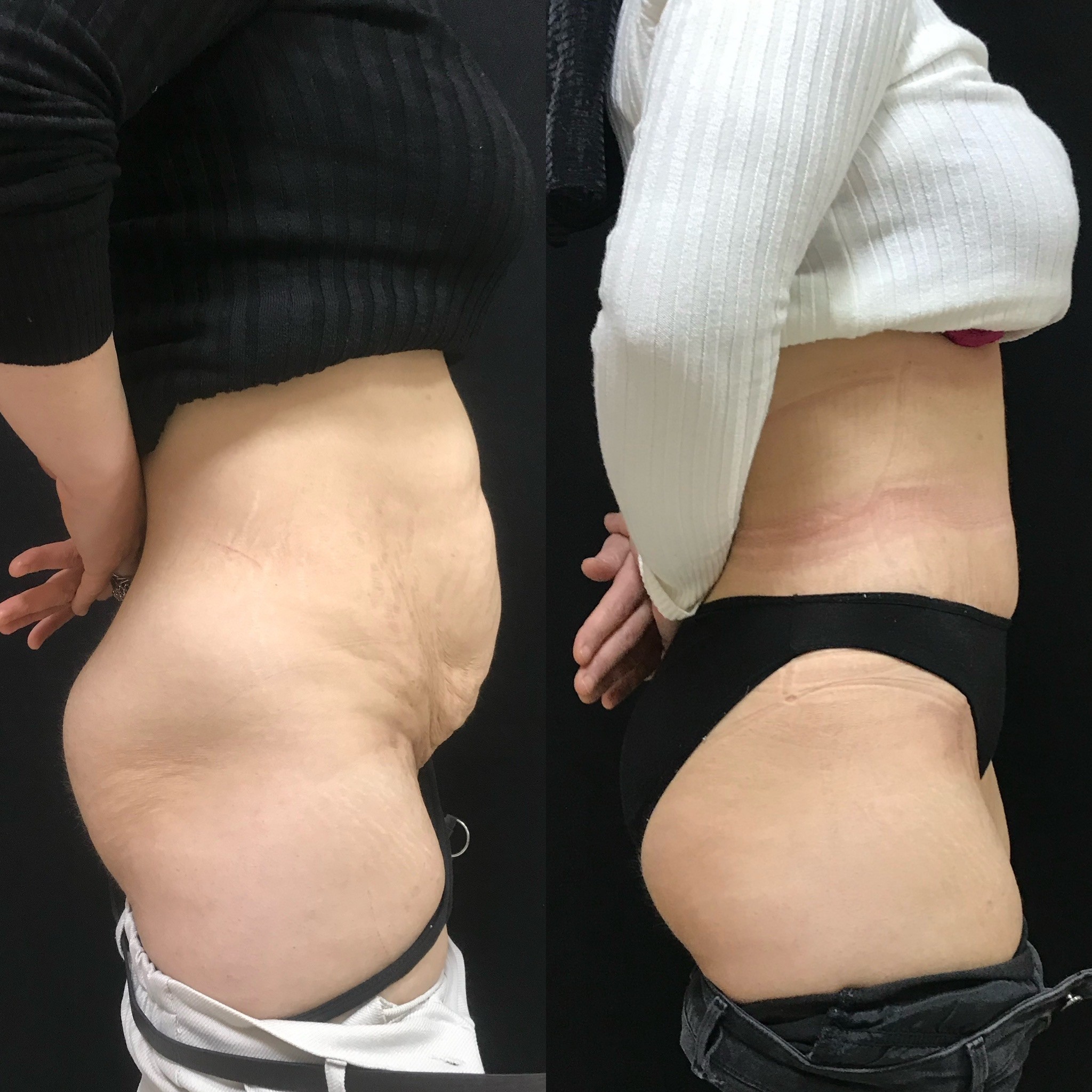 tummy tuck and liposuction before after result Istanbul, Turkey side view