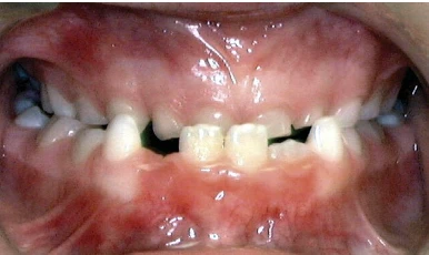 underbite