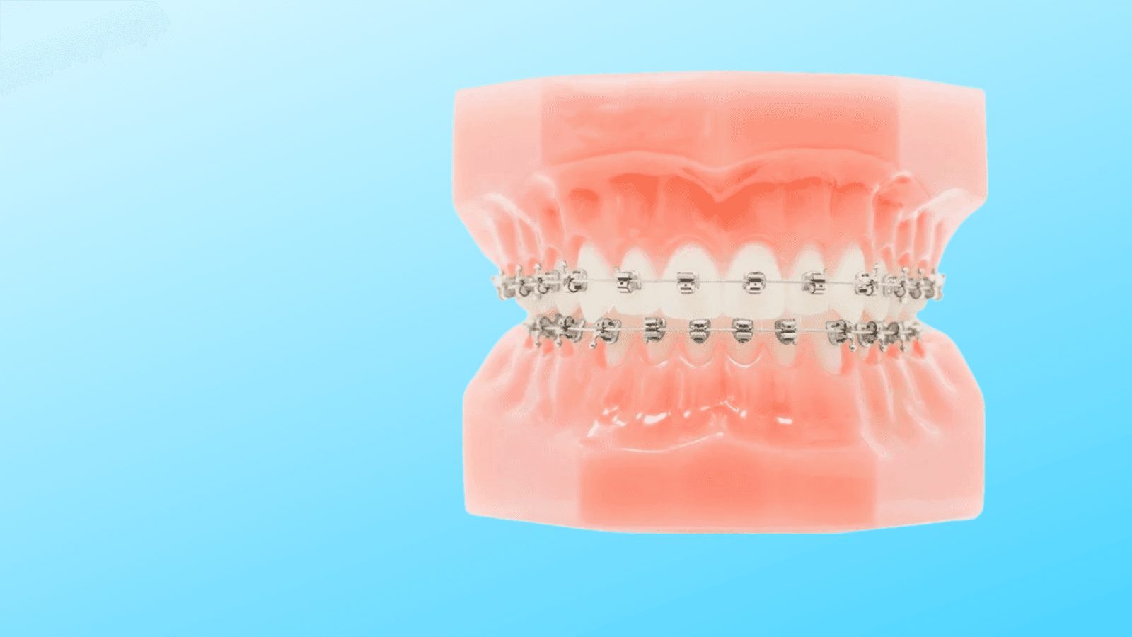SPEED System orthodontics - metal self-ligating braces at Midtown Orthodontics in Toronto, Ontario