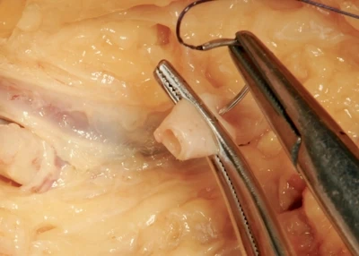 Vascular injury management