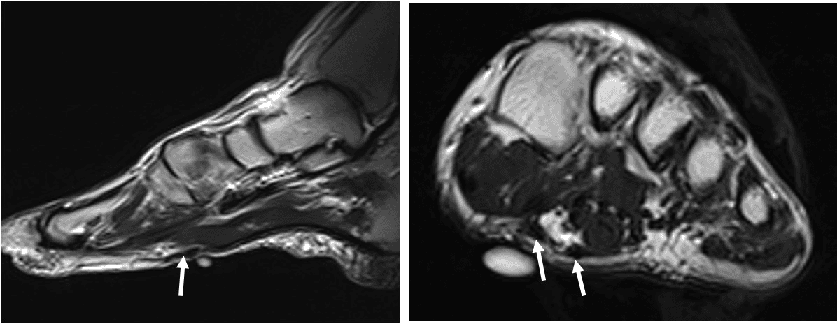 x-ray of fibromatosis