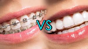 A close-up comparison of two smiling mouths—one with traditional metal braces and the other with clear Invisalign aligners—highlighting the visual difference in orthodontic treatments. This side-by-side image supports the question: are Invisalign better than braces for a discreet and comfortable teeth-straightening experience?