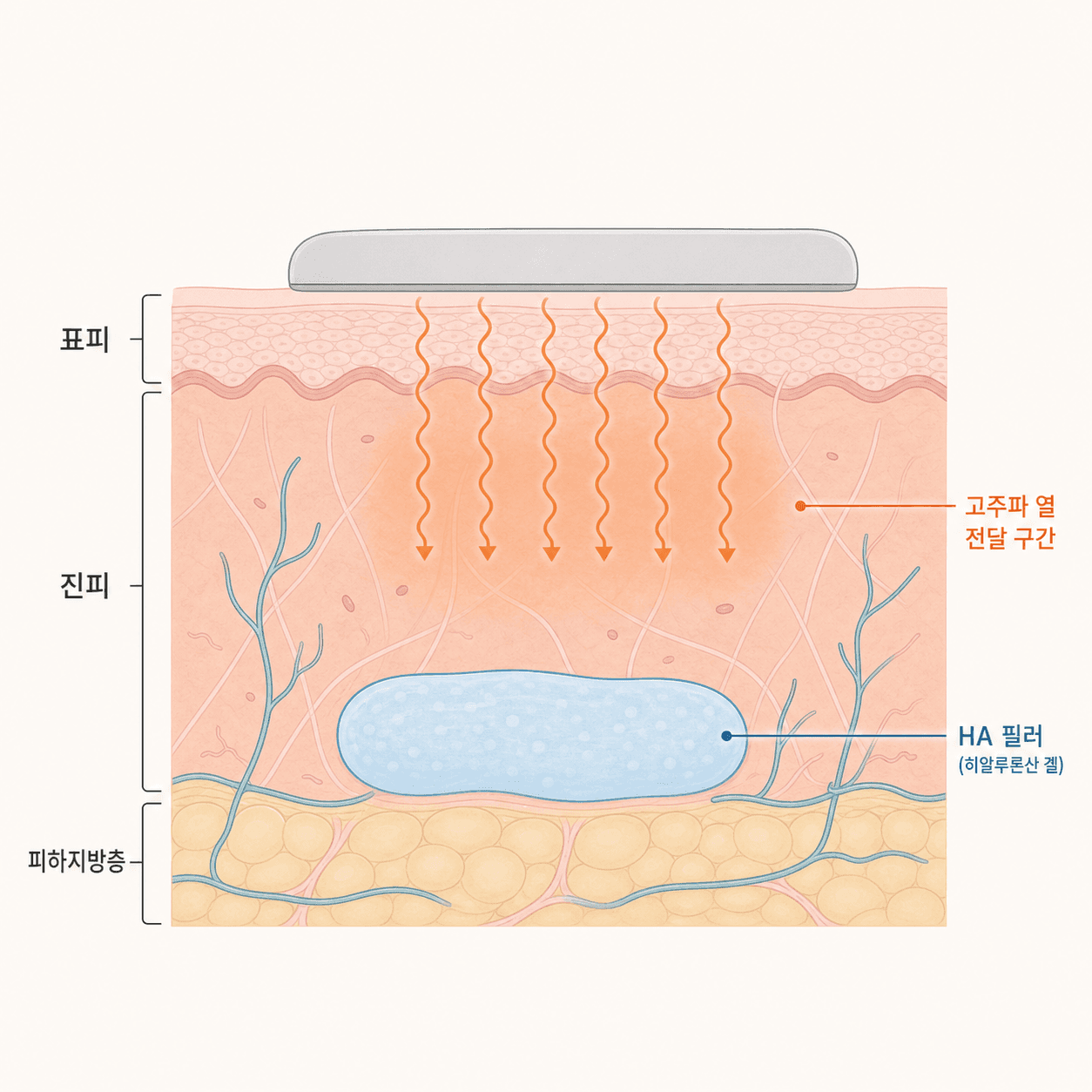 진피층 내 HA 필러와 고주파 열 전달 구간