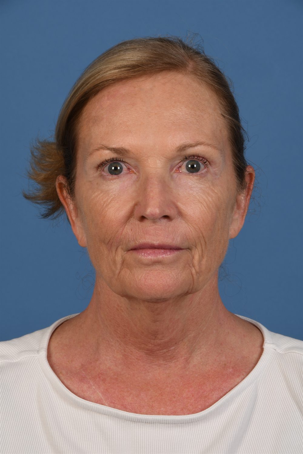 Facelift patient before surgery, front, relaxed