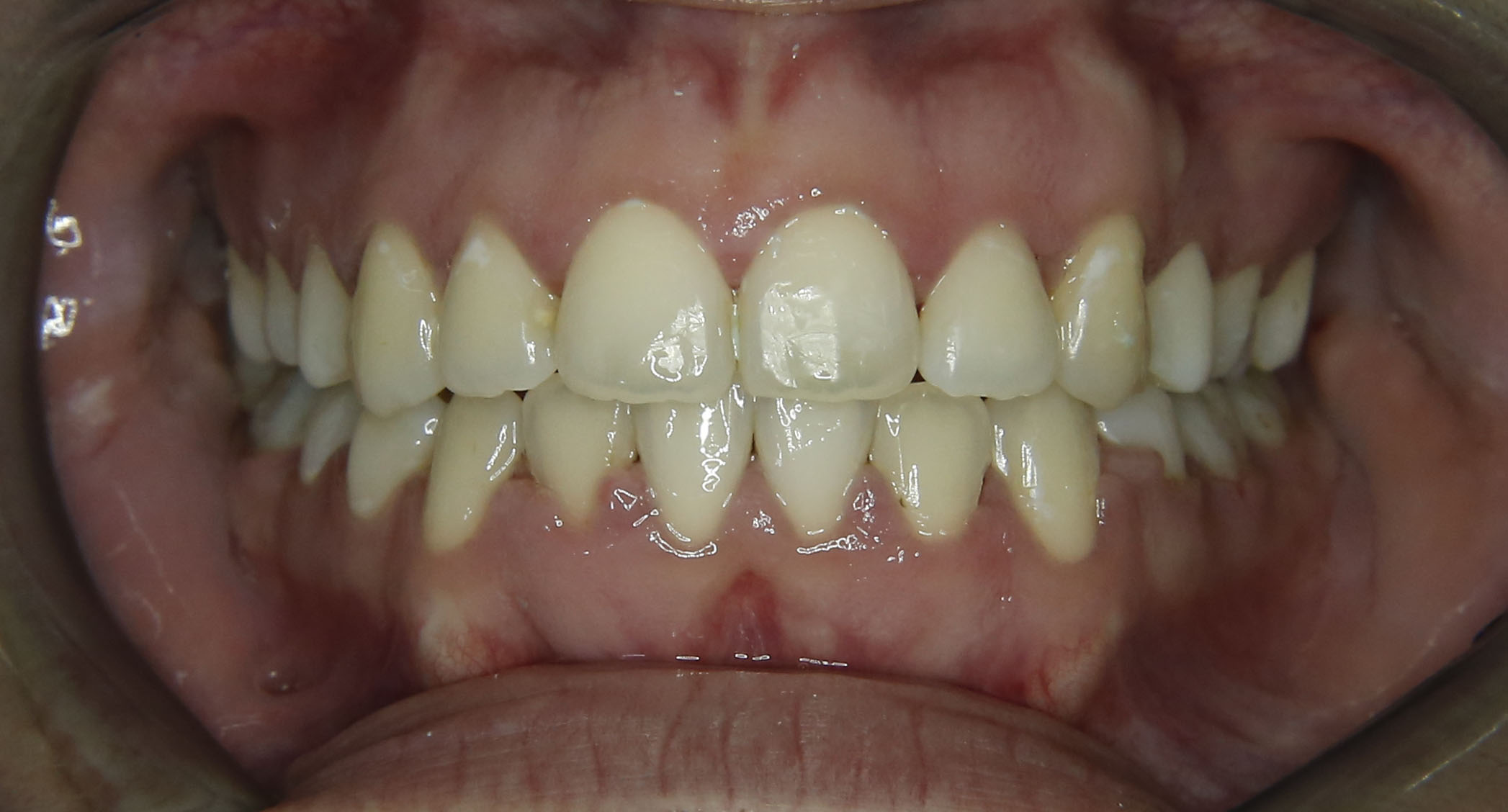 Dentist performing professional teeth cleaning on a patient in a clinic