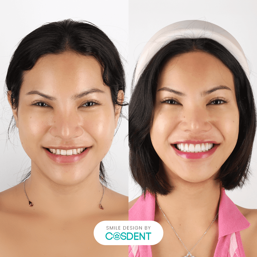 หน้าเพชร ยิ้มกว้าง 18 ซี่