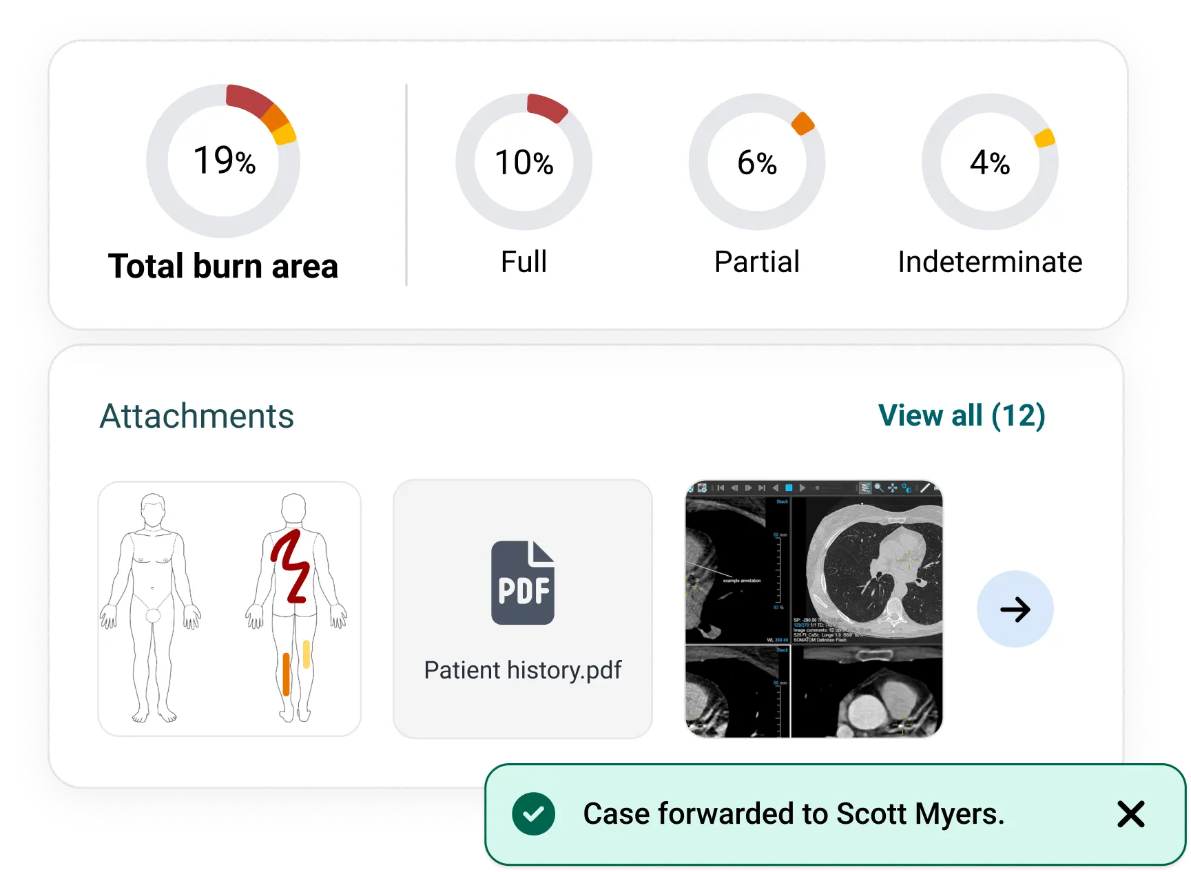 Screenshots from a Vula case, showing percentages of burns, and attachments of diagrams of burns, scans, and a patient history PDF. 