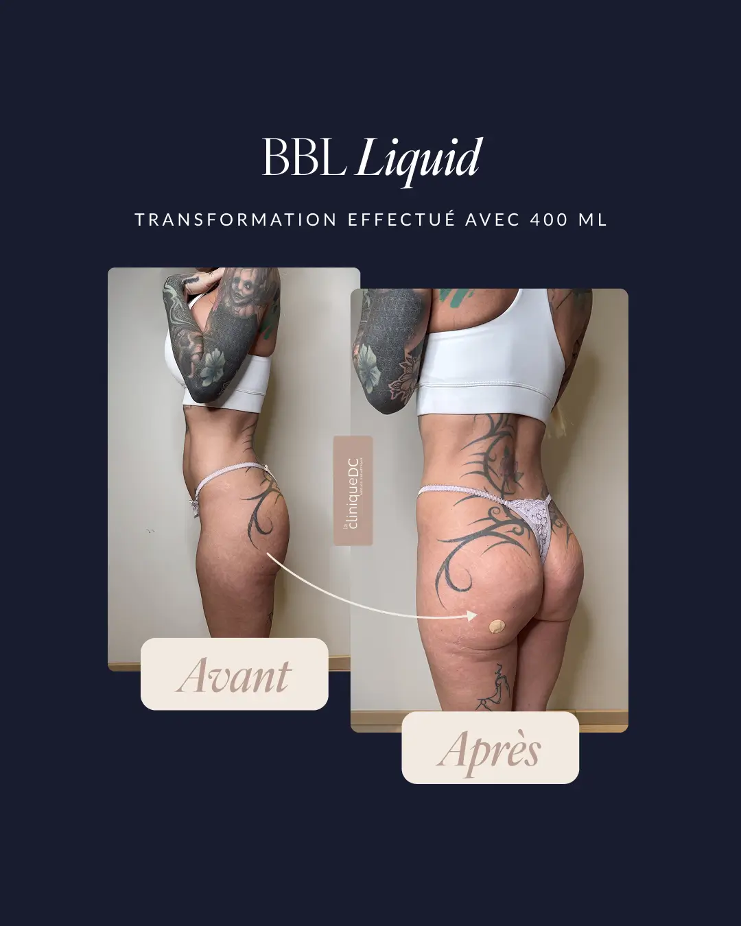 avant-après epilation laser visage dame agée