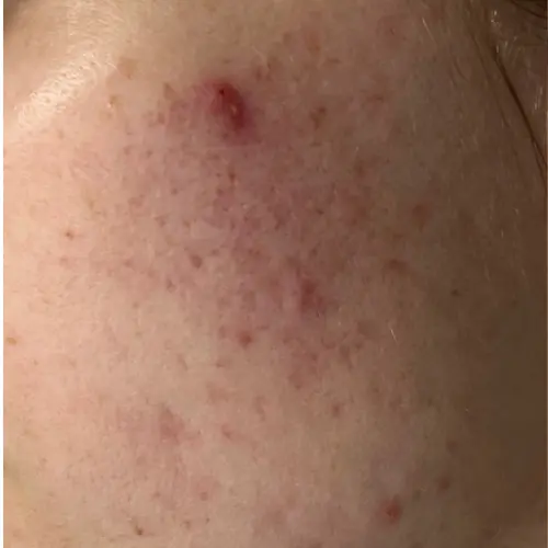 Before microneedling acne scar treatment at The Vancouver Aesthetician — visible pitted craters and post-acne scarring on skin