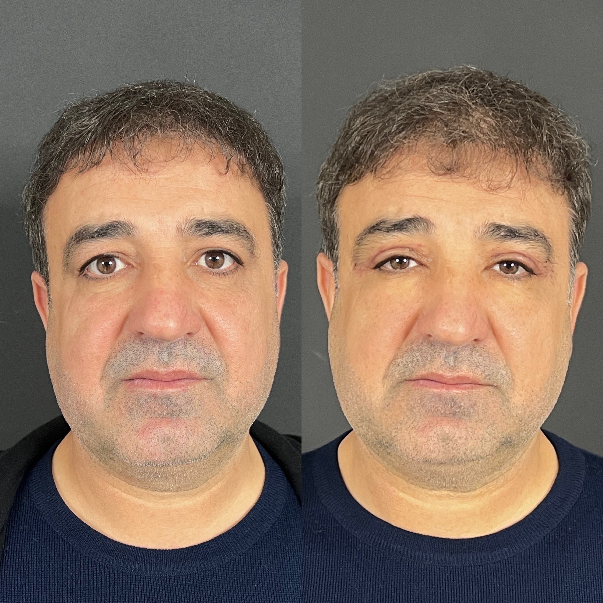 6 days before after upper blepharopalsty front view