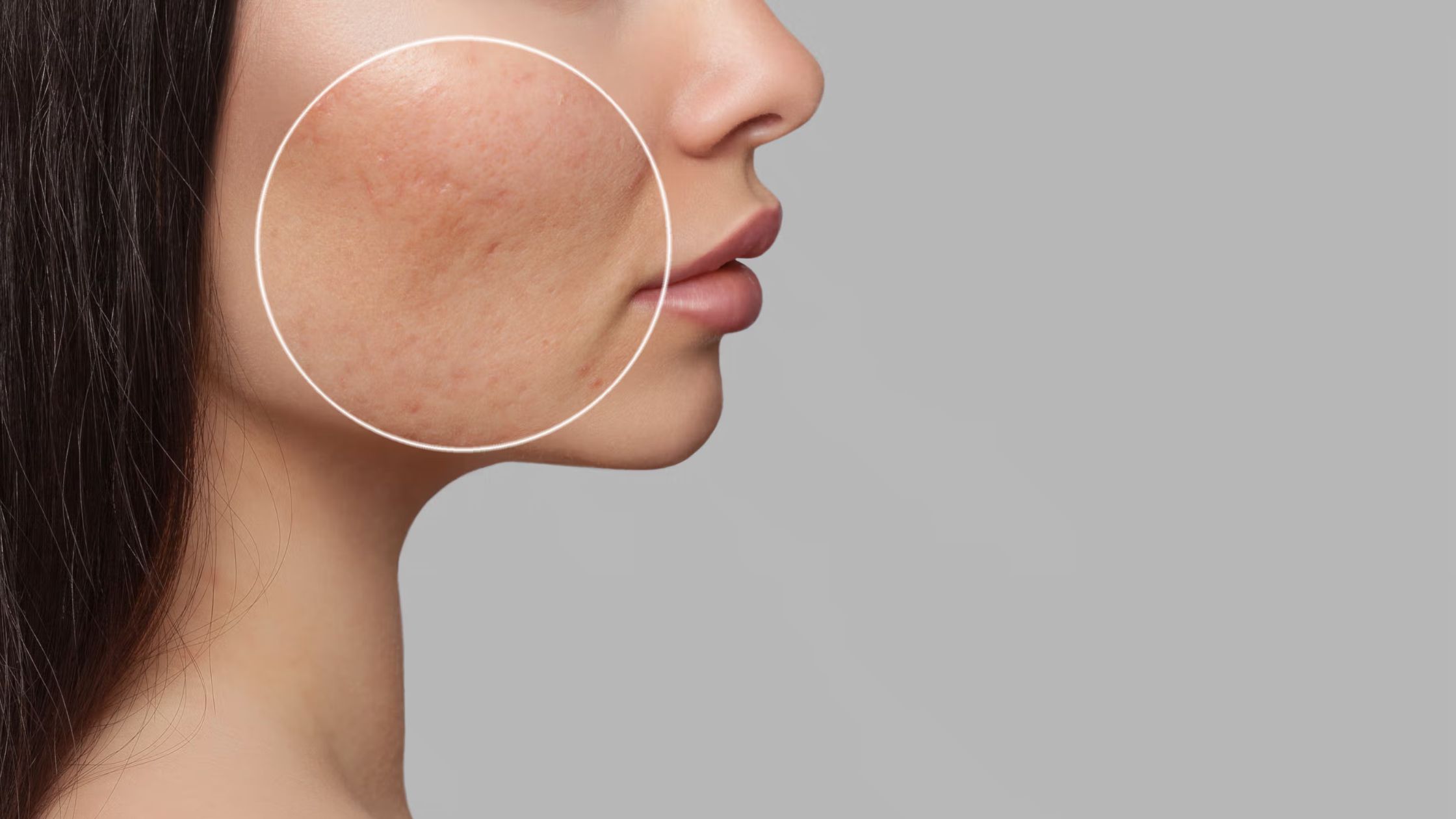 Microneedling for Acne Scars in Frisco