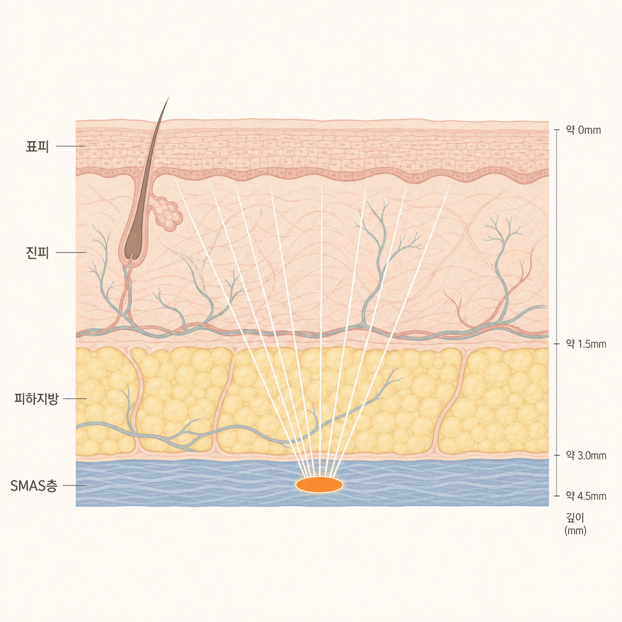 HIFU 에너지가 수렴하는 피부 층 단면 — 표피·진피·피하지방·SMAS층