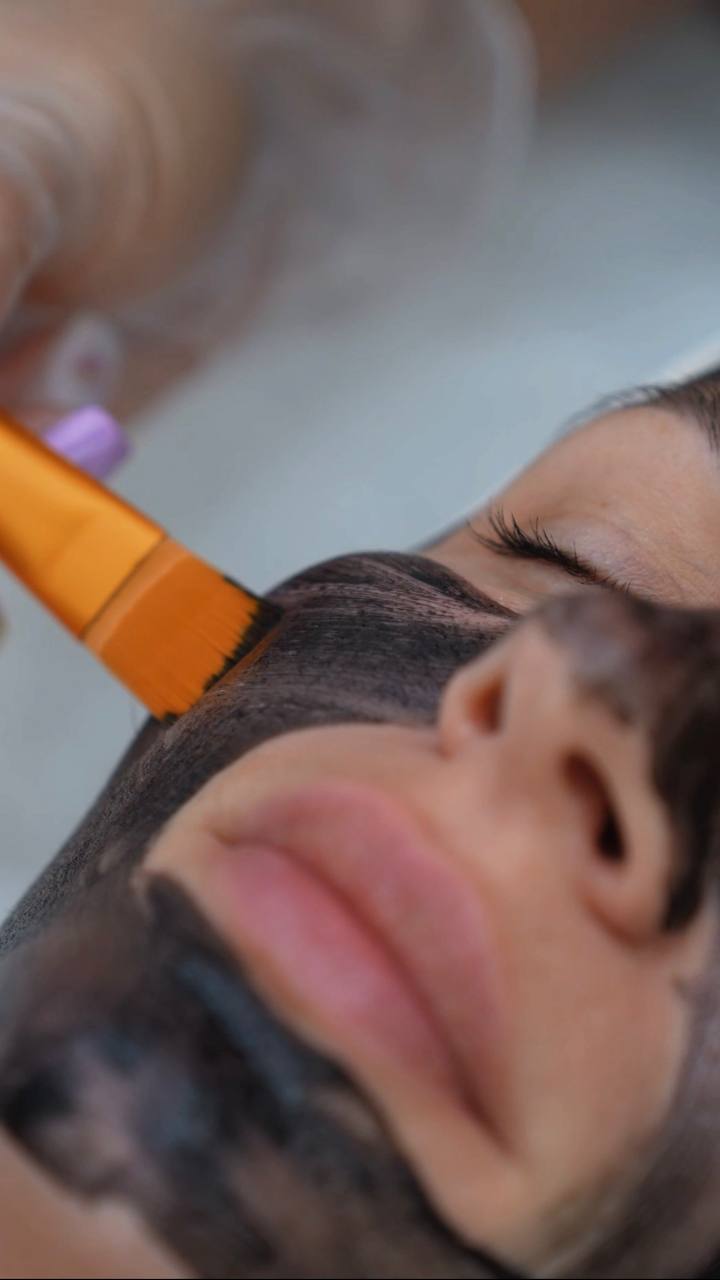 Carbon peel facial in Boston